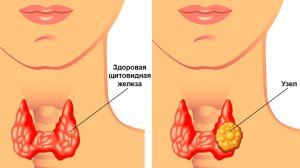 Как приготовить СРЕДСТВО для щитовидной ЖЕЛЕЗЫ из гречневой крупы, грецких орехов и мёда!