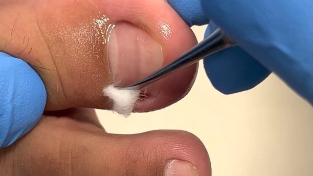 Severe looking toenails, found to be fine when trimmed【Xue Yidao】 смотреть онлайн