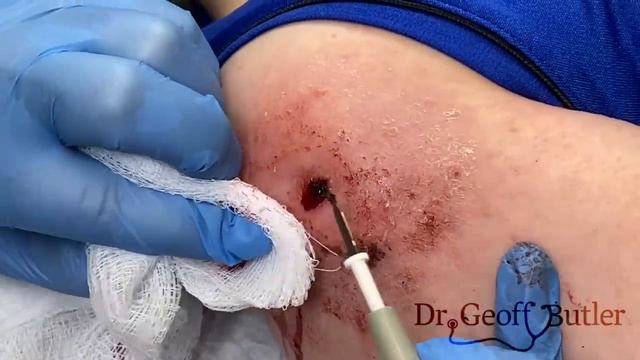 Removal of a Pyogenic Granuloma смотреть онлайн