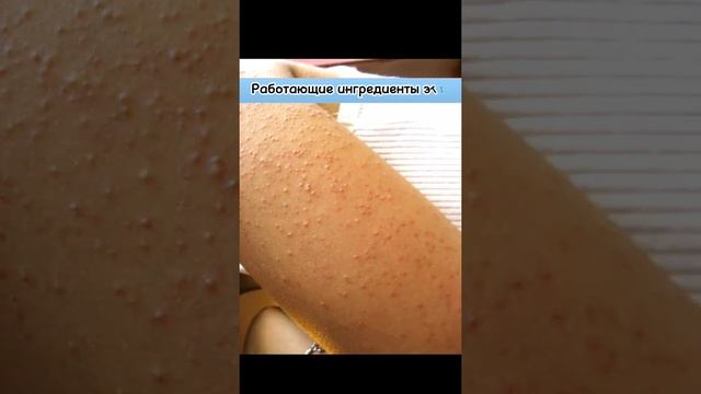 ?Пупырышки на руках? ?Гусиная кожа ? смотреть онлайн