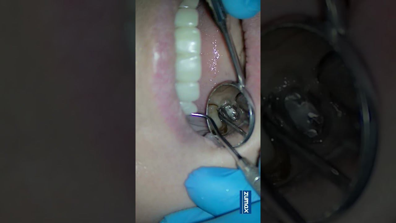 ретракция ватой, отлично работает при глубоких уступах смотреть онлайн