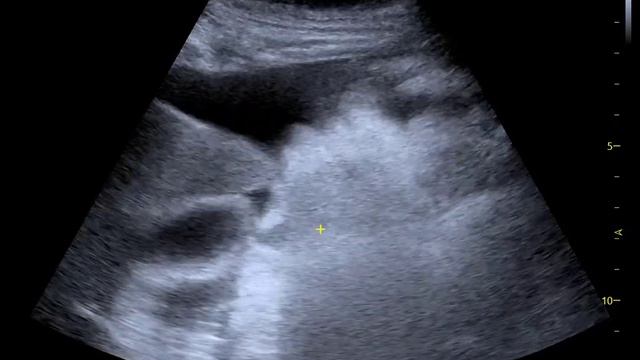 ascites on abdominal ultrasound смотреть онлайн