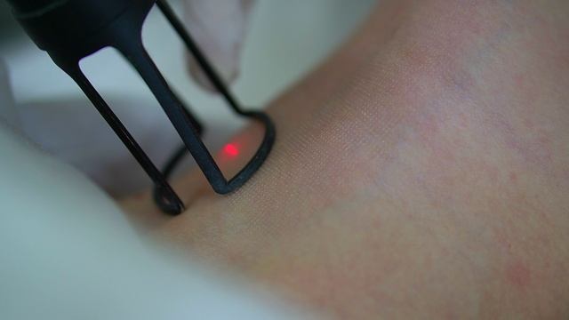 Фракционное лазерное омоложение.mp4 смотреть онлайн