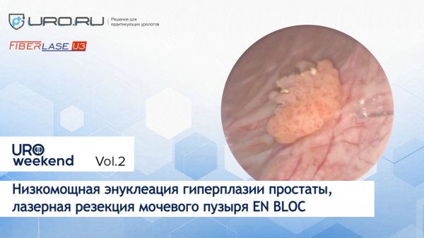 Низкомощная энуклеация гиперплазии простаты, лазерная резекция мочевого пузыря EN BL (Дымов А.М.)