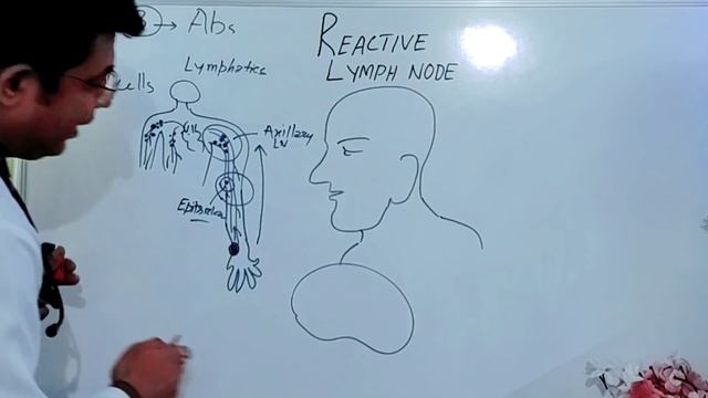 Reactive lymph nodes? Causes, symptoms, Treatment #lymphnodes #fnac #doctor смотреть онлайн