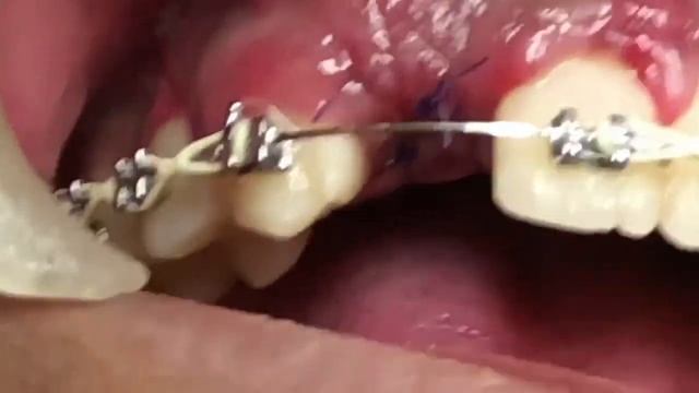 5 Case Studies of Dental Procedures/Surgeries with Dr. Tatch | StellaLife смотреть онлайн