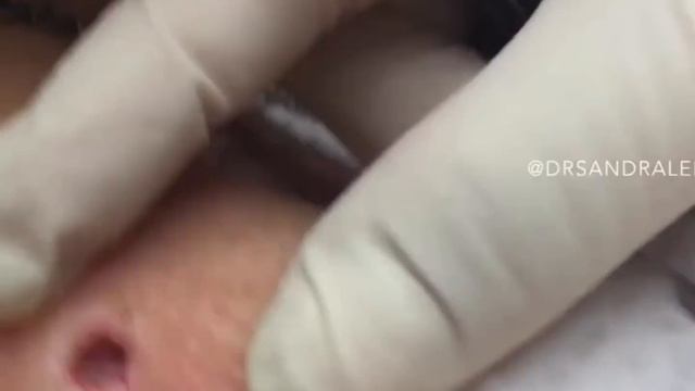 85 Year Old Blackhead! Dr Pimple Popper Most Popular Pop of ALL TIME! смотреть онлайн