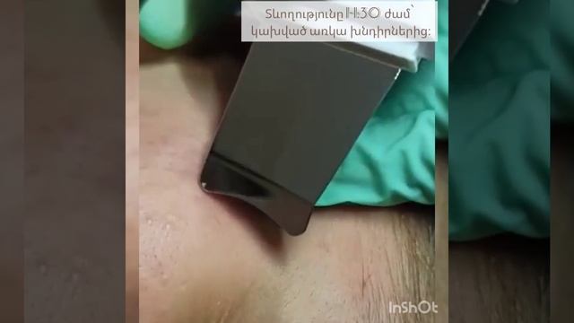 Механическая чистка лица// Ультразвуковая терапия и пилинг// Դեմքի ուլտրաձայնային մաքրում//