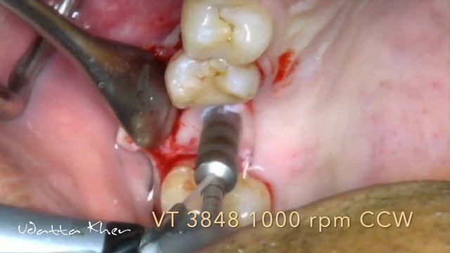 Crestal sinus lift with Densah protocol смотреть онлайн