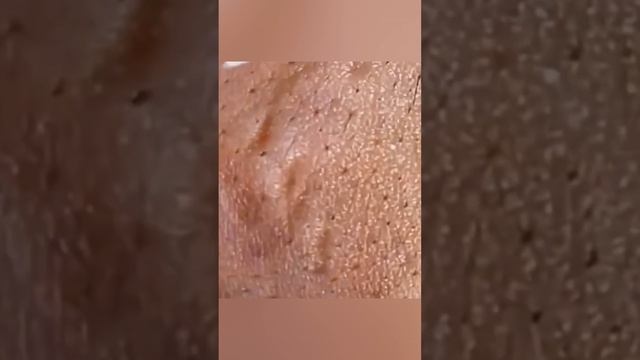 Pimple-Popping Party: Watch Skin Transformation