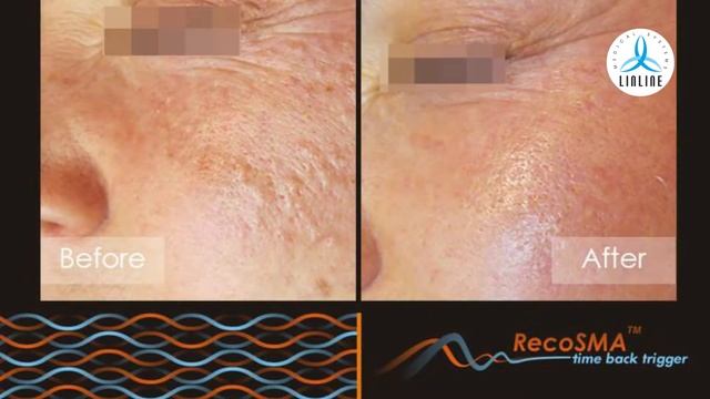 RecoSMA: skin becomes crystal clear смотреть онлайн