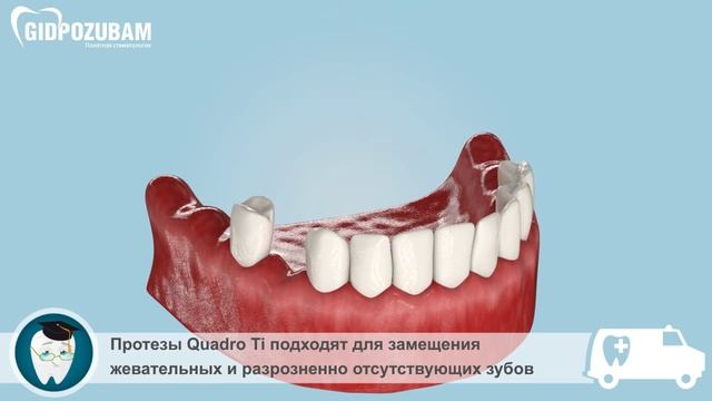 Съмные зубные протезы: съемный зубной протез Quadro Ti смотреть онлайн