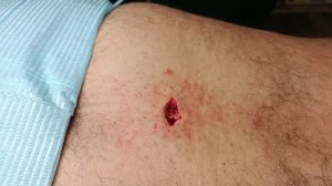 Удаление папилломатозного невуса спины