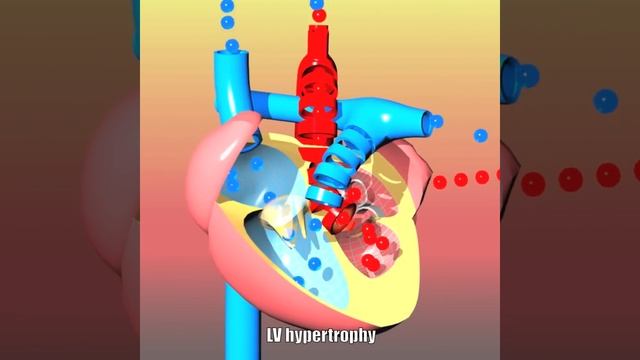 Congenital heart defects I: ASD, VSD, AS, PS, PDA and PFO смотреть онлайн