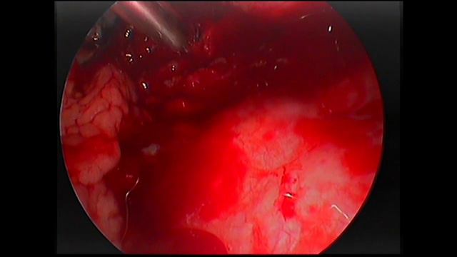 Аденоидэктомия