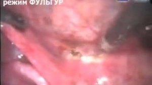 Девитализация эндометриоидных очагов малого таза методом аргоноплазменной коагуляции