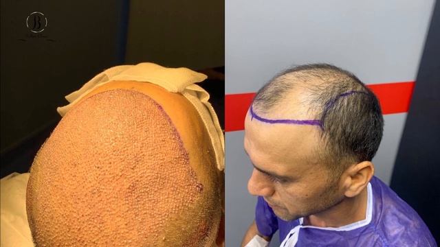 Пересадка волос до и после смотреть онлайн