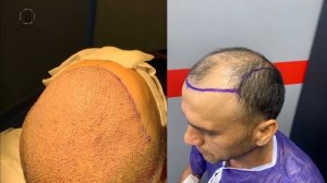 Пересадка волос до и после