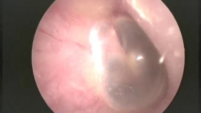 Otoskopie Valsalva-Versuch смотреть онлайн