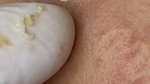 Чистка лица от червяков. Комедоны.