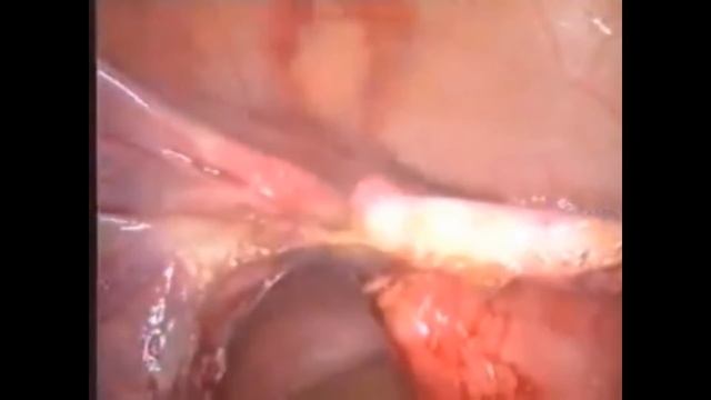 Лапароскопия в гинекологии смотреть онлайн