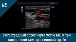 УЗИ Вен. Ретроградный сброс через устье МПВ при дистальной компрессионной пробе.
