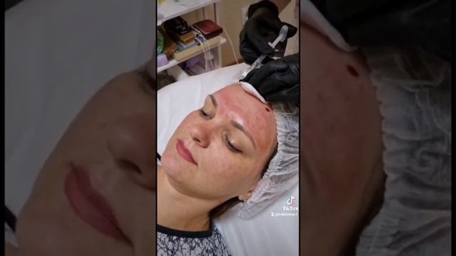Как делают уколы красоты? смотреть онлайн