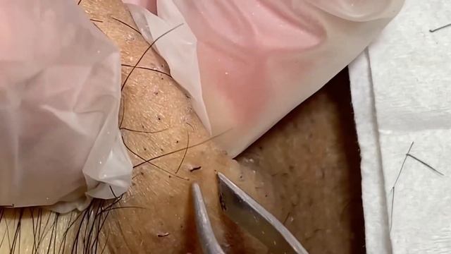 Вросшие волосы / Воспаление волос на теле #тело #волосы #вросшие смотреть онлайн