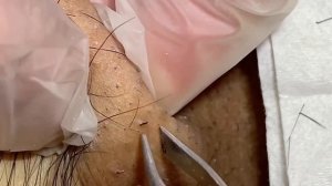 Вросшие волосы / Воспаление волос на теле #тело #волосы #вросшие