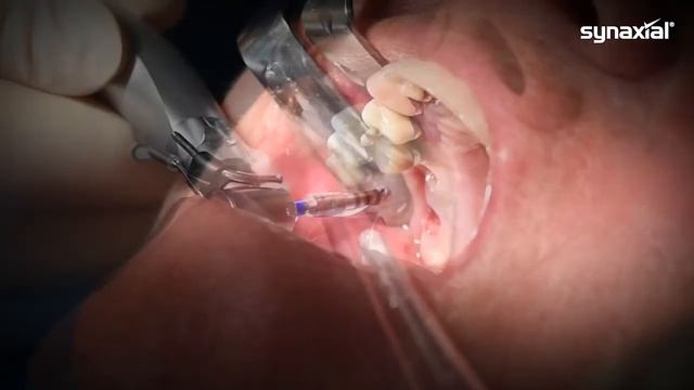 Transcrestal Sinus Lift With The SinusJet®