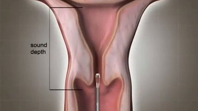 Установка и удаление ВМС смотреть онлайн