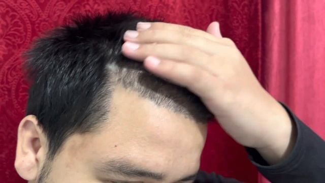 Day - 90 My Hair Transplant results / Hair Transplant in Nepal / Rabin thapa #hairtransplantinnepal смотреть онлайн