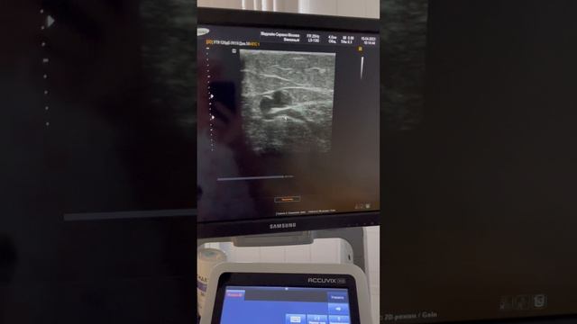 Нетипичная форма варикоза. Операция. Лечение вен. Флеболог Москва. Флеболог смотреть онлайн