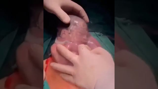 The miracle of a rare delivery - born without amniotic fluid ! This baby born while still encased смотреть онлайн
