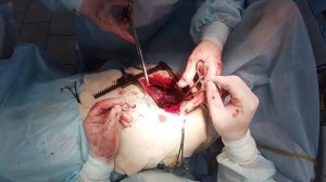 Буллезная эмфизема Легких.Пнемоторакс. Краевая резекция лёгких.Плевродез.Вullous emphysema