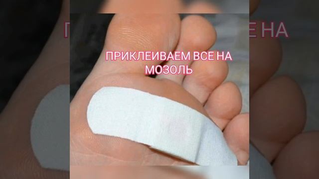 УДАЛЕНИЕ МОЗОЛЕЙ смотреть онлайн