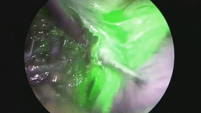 Sentinel lymph node mapping in patient with endometrial cancer using ICG, left obturator SLN (+) смотреть онлайн