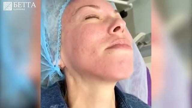 Завершающий этап лазерной шлифовки. БЕТТА КЛИНИКА, Нижний Новгород смотреть онлайн