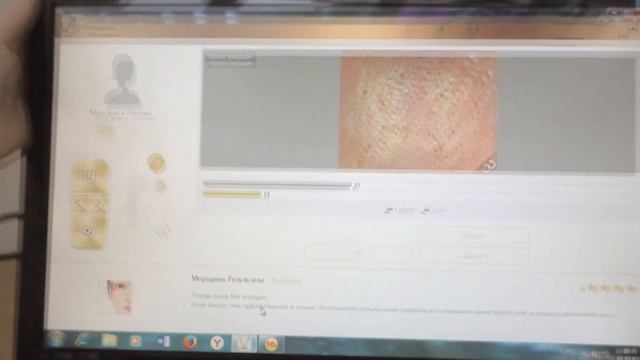 Компьютерная диагностика лица (Дерматоскопия) в санатории Пирогова смотреть онлайн