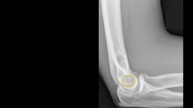 Anatomy of Elbow X-rays смотреть онлайн