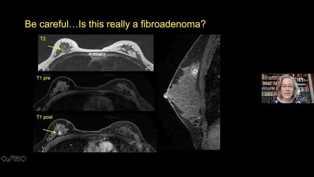 Breast MRI – Lesion Analysis and Interpretation, Dr. Priscilla Slanetz - MRI Online Noon Conference смотреть онлайн