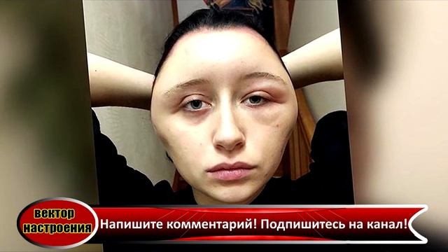 У девушки увеличилась голова на 7 см и распух язык после покраски волос! смотреть онлайн