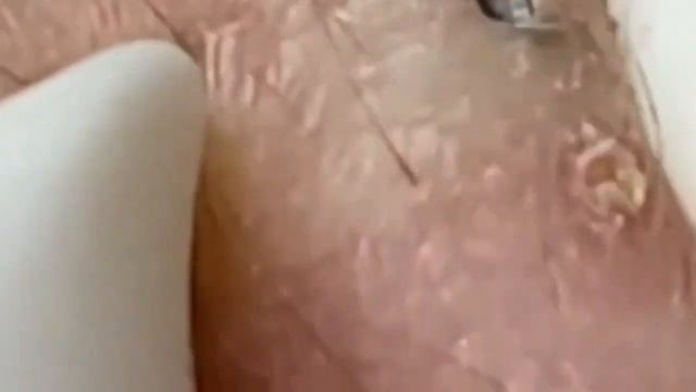 Залипающее видео! Прыщи. Акне. Выдавливание прыщей