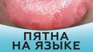 Пятна на языке.