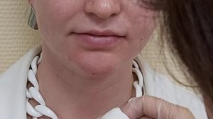 Медилайт изменение формы подбородка. Филлер для коррекции формы лица