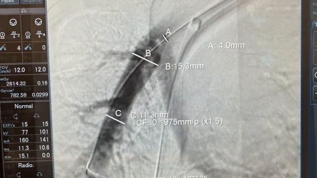 Cyclical Aspiration Using Insera Catheters in New York (In Vivo Use) смотреть онлайн