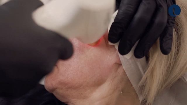 Resurfx fractional non-ablative skin resurfacing at Quinn Clinics Bristol смотреть онлайн