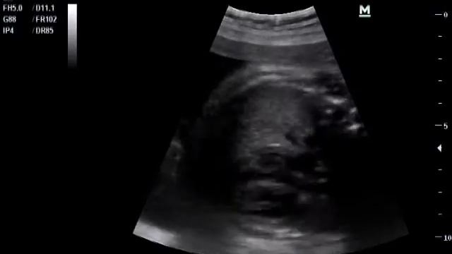 Хорда правого предсердия смотреть онлайн