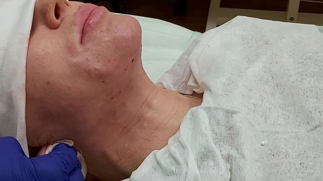 Нити для лифтинга, брыли, складки, морщины, заломы. смотреть онлайн