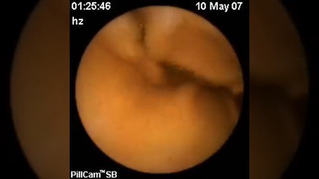 Начало регенеративного восстановления (май 2007)